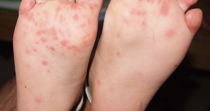 Typische rote Bl&auml;schen der Hand-Fu&szlig;-Mund-Krankheit an den Fu&szlig;sohlen eines Kindes