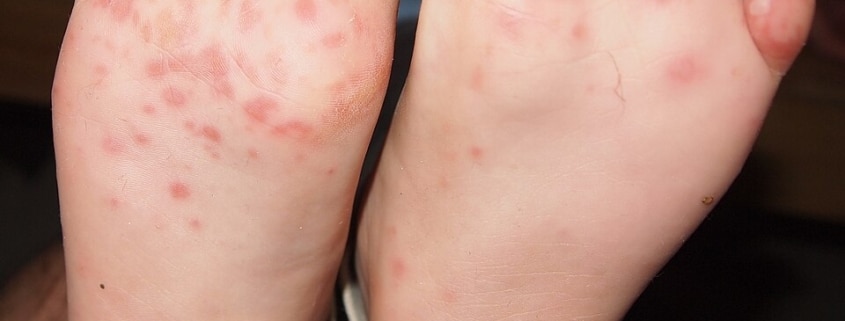Typische rote Bläschen der Hand-Fuß-Mund-Krankheit an den Fußsohlen eines Kindes