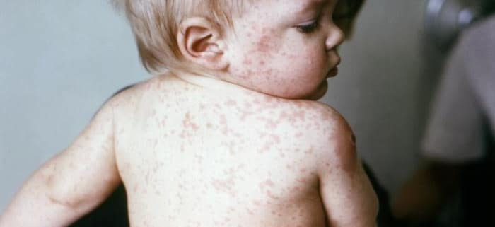 Masern: Symptome, Impfpflicht & warum sie ernst zu nehmen sind 1 Großfleckiger Masern-Ausschlag am Rücken eines Kleinkindes