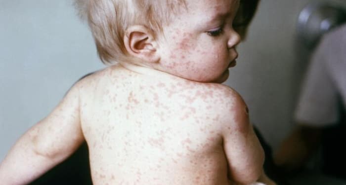 Masern: Symptome, Impfpflicht & warum sie ernst zu nehmen sind 1 Großfleckiger Masern-Ausschlag am Rücken eines Kleinkindes